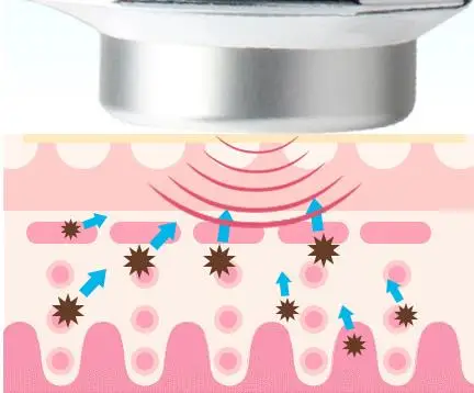 1 MHz ultrasunete corp de îngrijire a pielii faciale frumusete de masina, cu ultrasunete de regenerare a ridurilor pentru a elimina acnee, pigmentare